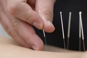 physiotherapy in littlehampton, physio, arundel, rustington, rehab, taping, acupuncture, physiotherapist, needling, dry